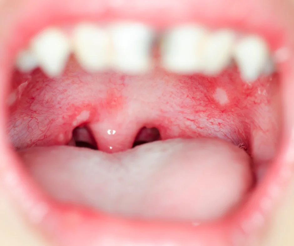 aphthous ulcers tongue