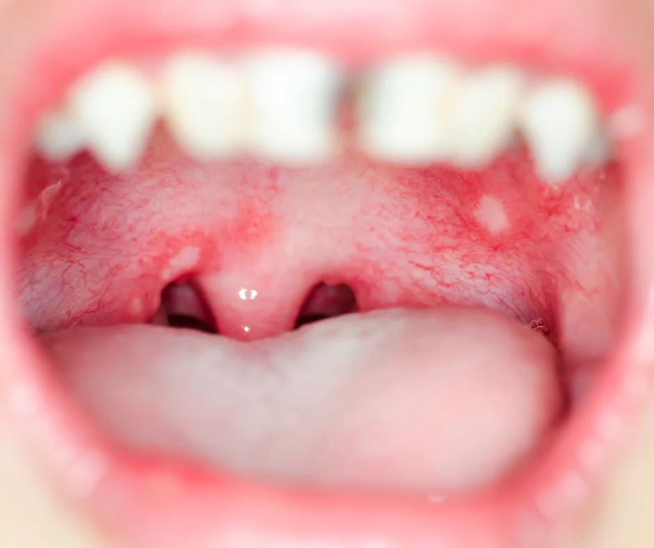 Everything You Need To Know About Mouth Ulcers Grange Family Dental